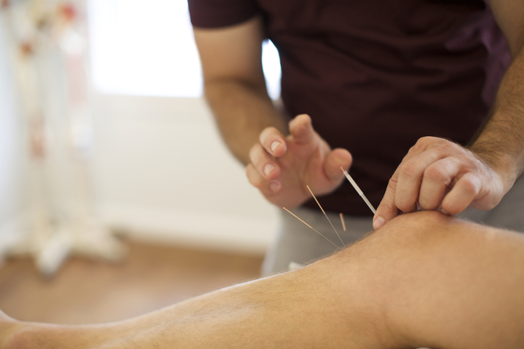 Acupuncture